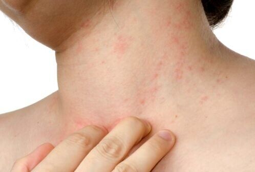 алергия към подкожни паразити